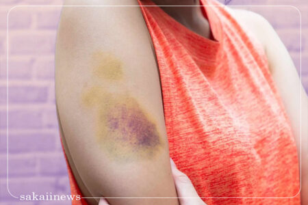 چرا به راحتی کبود می‌شویم؟