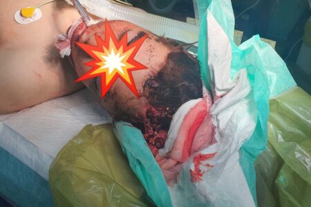 نجات جان دو جوان سراوانی با انجام عمل جراحی حساس و شگفت آور در بیمارستان رازی سراوان