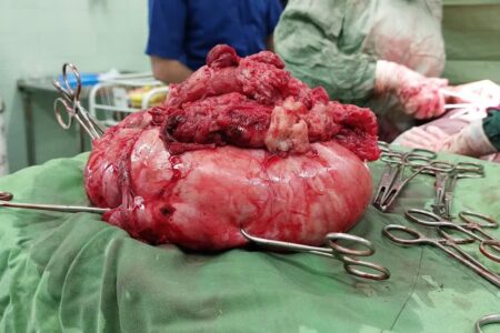 پزشکان زاهدانی توده ۶ کیلوگرمی از شکم یک بیمار خارج کردند